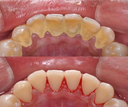 preventia-dentara