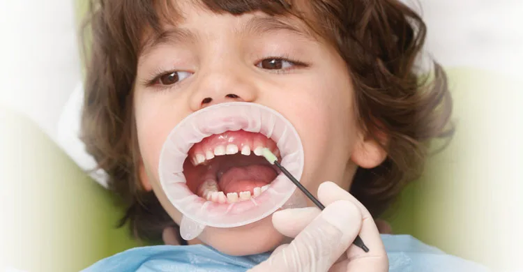 fluorizare-dentara-copii