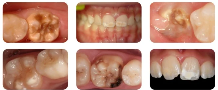 sindrom-hipomineralizare-molar-incisiv